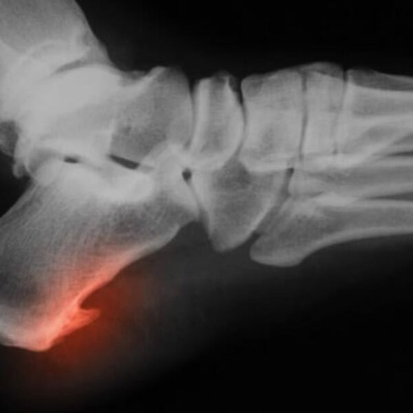 BONE SPURS